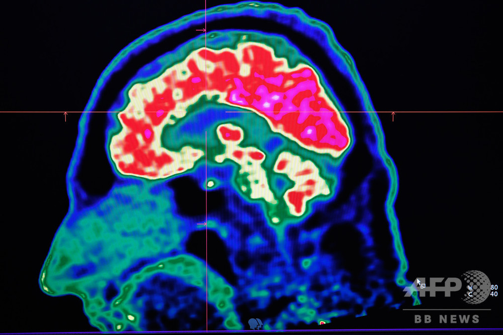 「痛み信号」を脳内で増減、仕組み解明 研究