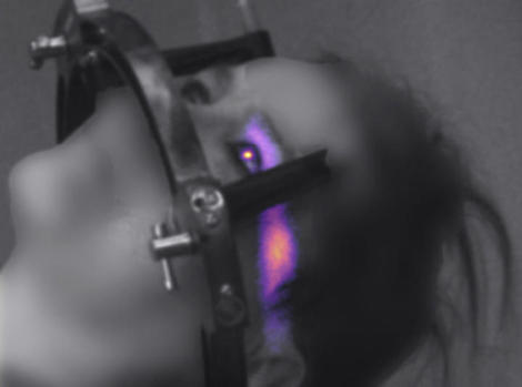 放射線治療中、目が発光している様子がはじめて撮影された　その正体は？