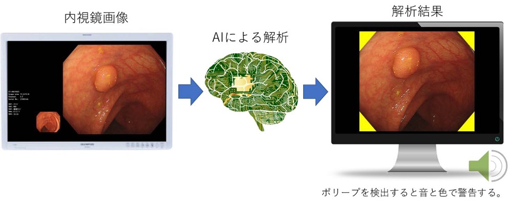 AIによる内視鏡診断支援ソフトウェアが医療機器の承認を取得