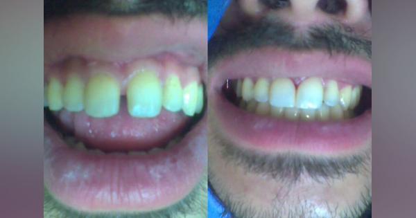 20年悩んだすきっ歯を、40分で解決したタイの歯科の衝撃