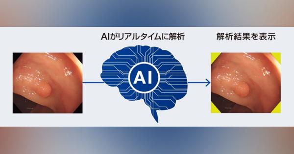 AIで大腸内視鏡画像を解析する、内視鏡画像診断支援ソフトウェアを発売