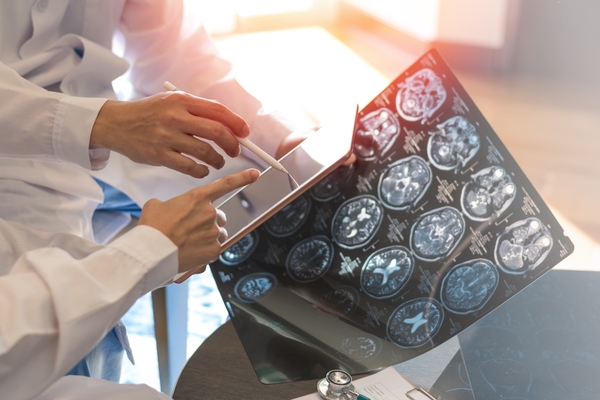 脳のMRI画像2,000例以上をAIで解析！アルツハイマー病の発症時期が予測可能に