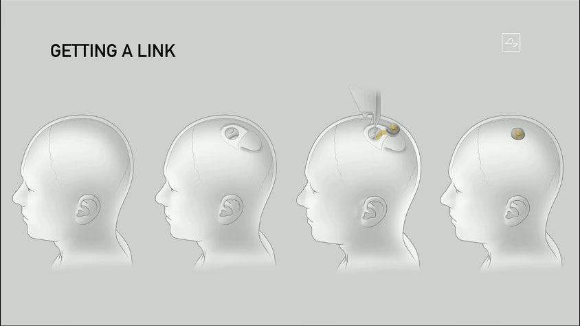 イーロン・マスク「頭のFitbit」こと脳埋込みAIチップ「Link」発表。自動手術ロボV2も
