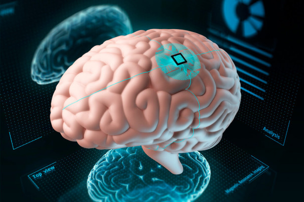 体がまひの患者　脳インプラントでコンピューター制御が可能に