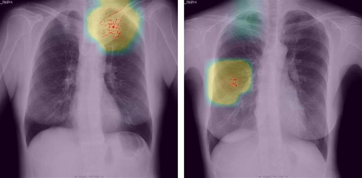 ＡＩベンチャーのプリファード　胸部Ｘ線診断ＡＩを開発