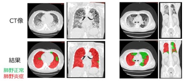 COVID-19肺炎、CT画像からAI解析する手法開発