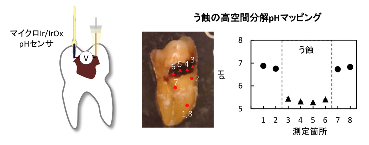 見えない虫歯も発見可能に - pHマッピングでう蝕の定量的検査技術を開発