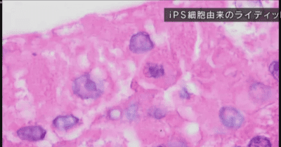 神戸大学　iPS細胞由来　男性ホルモン合成する細胞作製に成功