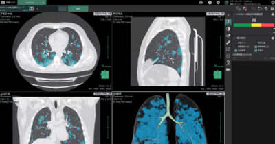 富士フイルムが開発 新型コロナ肺炎の画像診断支援ソフトの実力【コロナ禍でも注目 最新医療テクノロジー】