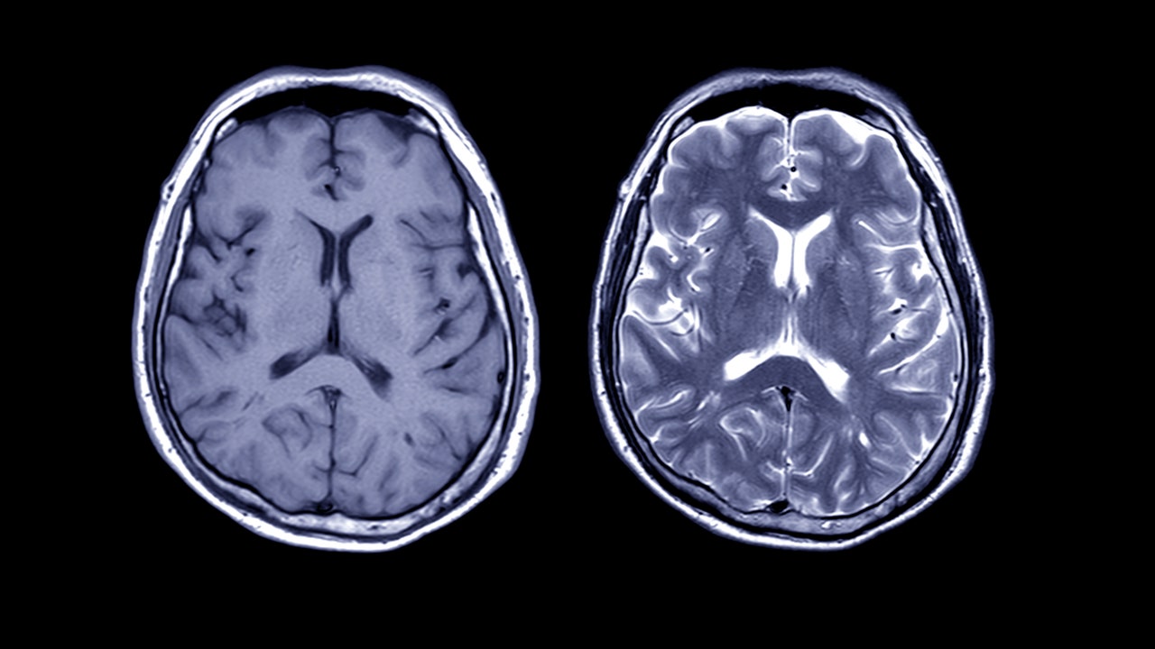 人間の脳を“デジタルツイン”としてコピーする：進化する神経疾患の治療と、見えてきた倫理的な課題