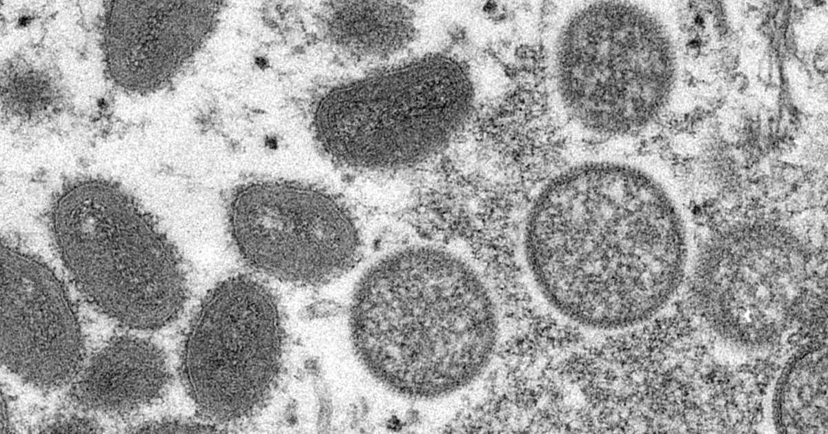 サル痘拡大　「極めて異常」ＷＨＯがヒト間の感染警告