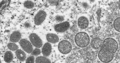 「サル痘」が世界に感染拡大！ ラクダ痘・天然痘の関係は医療情報学教授が解説