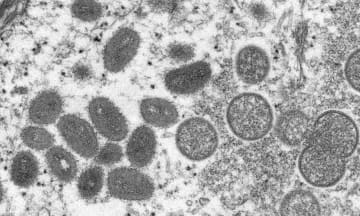 サル痘で緊急事態宣言検証　WHO、専門家が協議