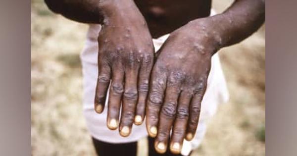 サル痘「やけどのような痛み」　ブラジルの感染者、体験語る