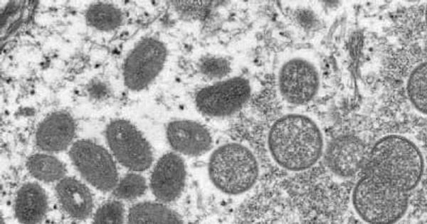 世界で急増中の「サル痘」はどんな病気？ 日本で初めて感染者確認、WHOは緊急事態宣言