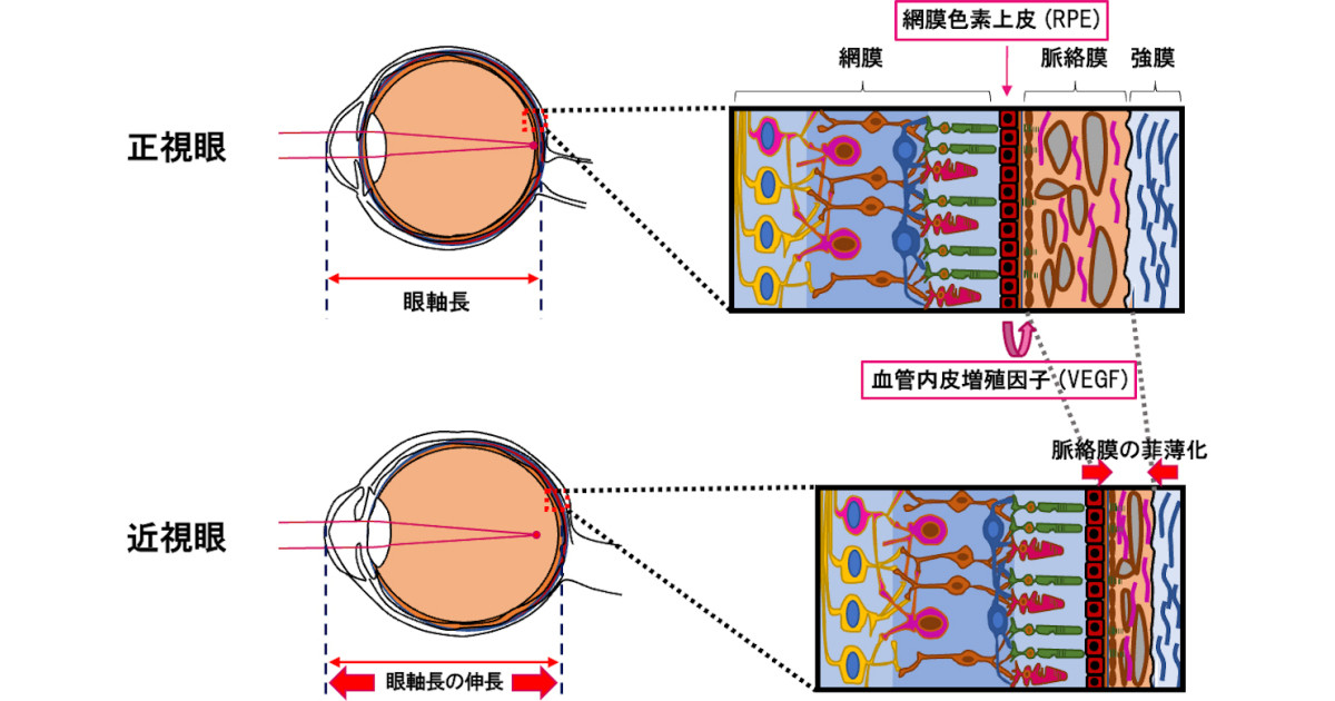 近視の進行抑制には網膜後方の血管の保護が有効、慶大が確認