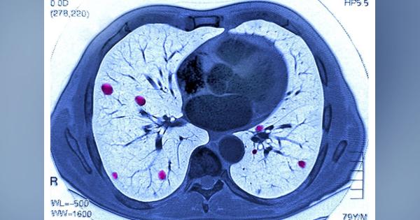 マサチューセッツ工科大学ら、肺がんを発見できるAIシステム開発
