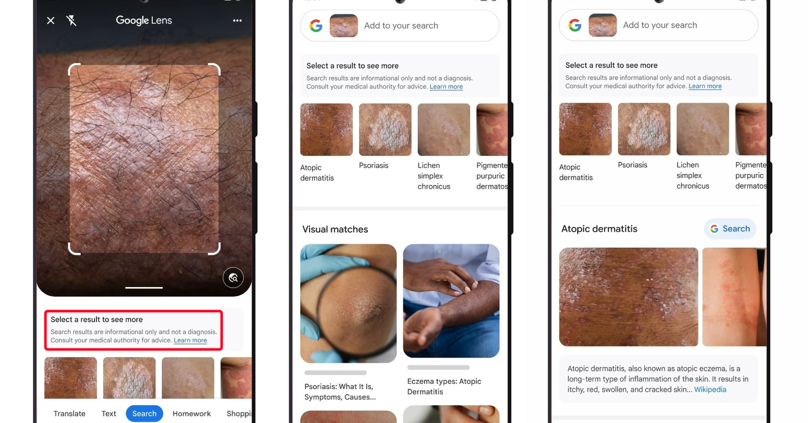 Googleレンズに「皮膚の状態を画像で検索」機能追加　間もなく「Bard」と提携も