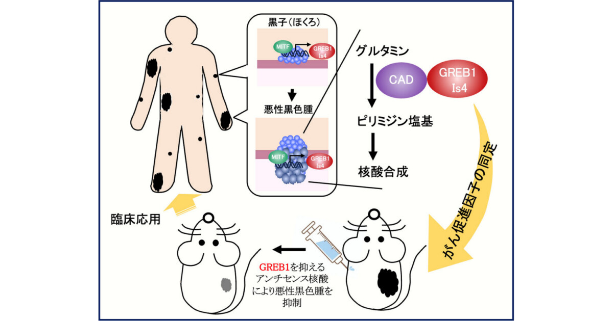 阪大、皮膚がん「悪性黒色腫」の治療のための新たな分子標的を発見