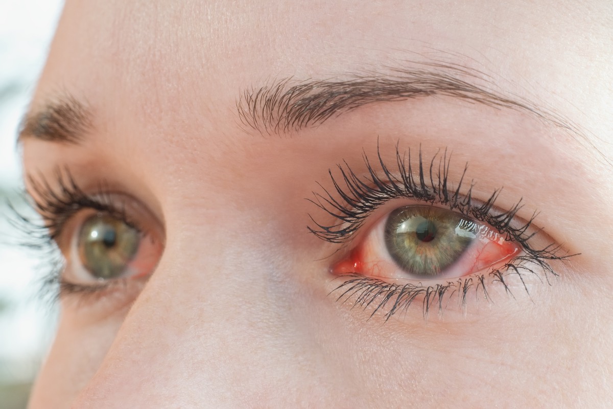 「目の充血・かゆみ」に悩む人へ　アレルギー性結膜炎には免疫療法が効果的