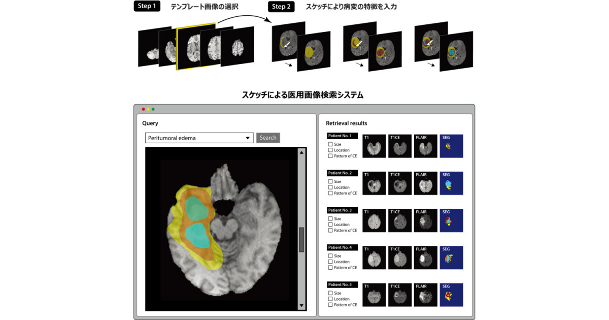 国がん、膨大なCT・MRIの画像をスケッチにより検索するAIを開発