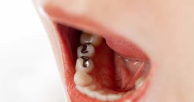 後悔しない歯科治療（1）「銀歯」は弊害が多く海外は禁止している