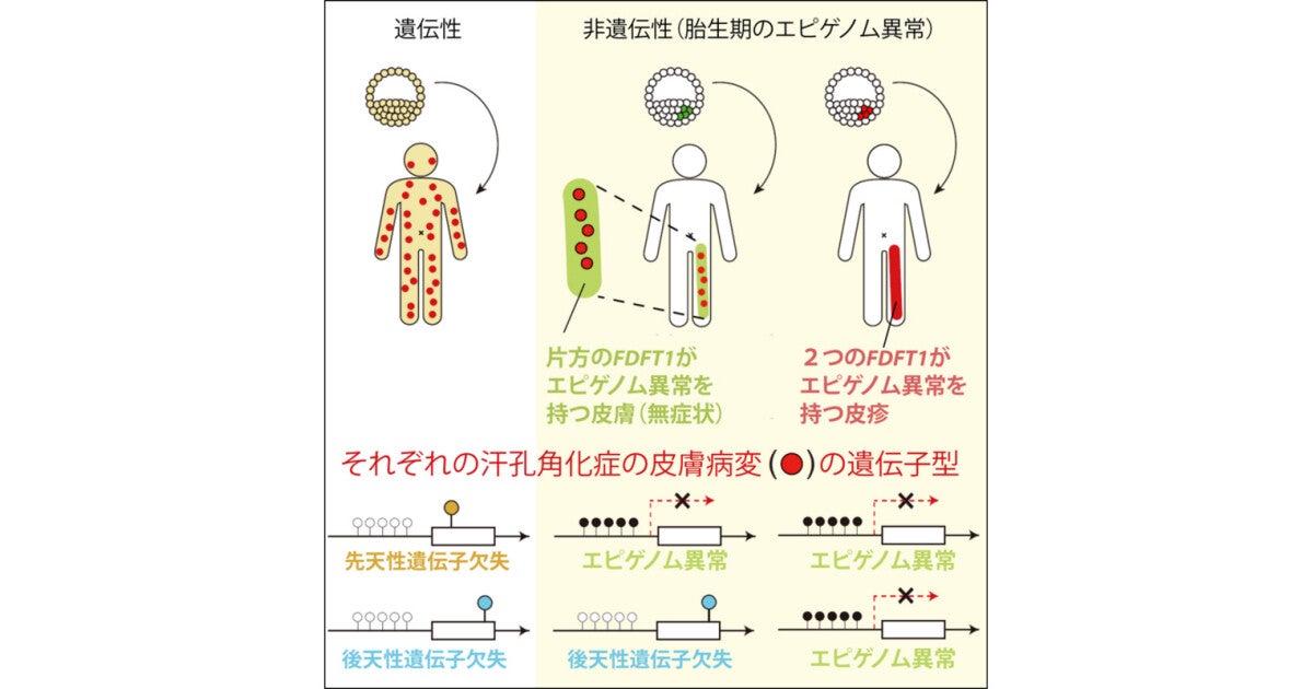 神戸大など、汗孔角化症の一部は「エピゲノム異常」で起きることを確認